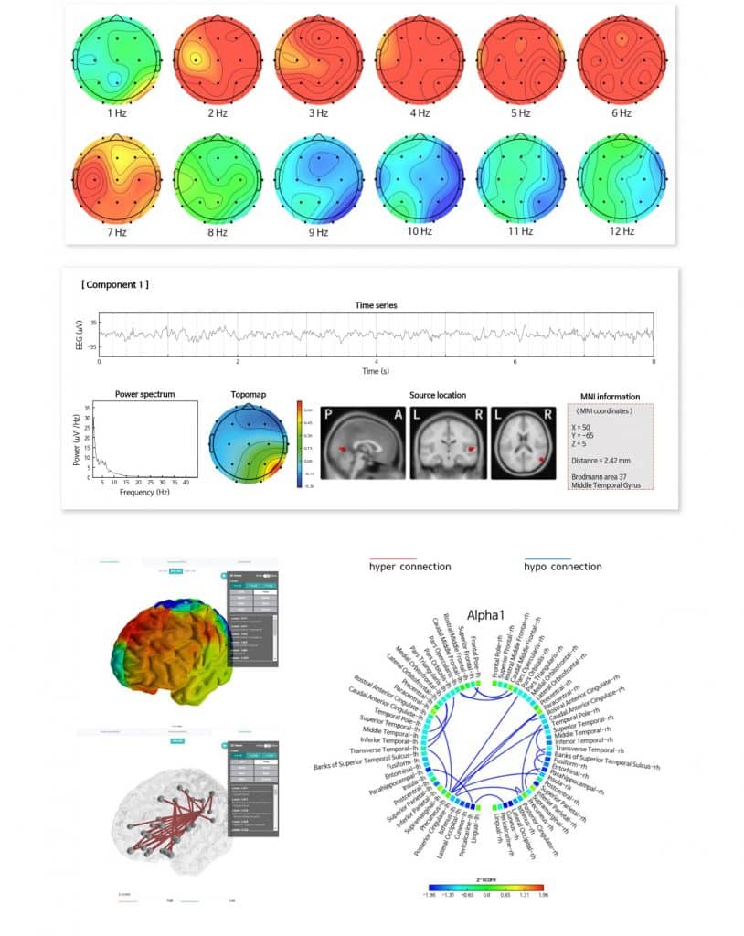 iMediSync unveils an innovative dry sensing EEG brain mapping and therapeutics device