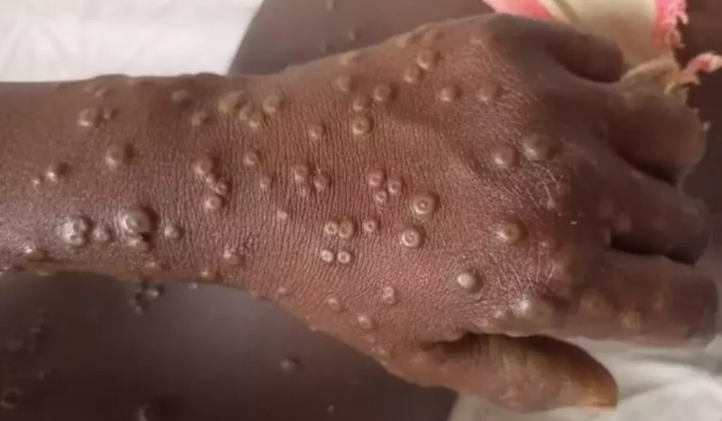 1831321 mpox India Mpox Cases: Monkeypox detected for First time in India! Check details on Symptoms, Prevention and Vaccines available