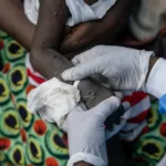 Kerala Second Mpox case: Kerala confirms a second incidence of Mpox, increasing statewide precautions