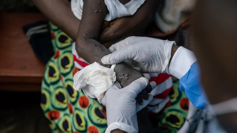 Kerala Second Mpox case: Kerala confirms a second incidence of Mpox, increasing statewide precautions