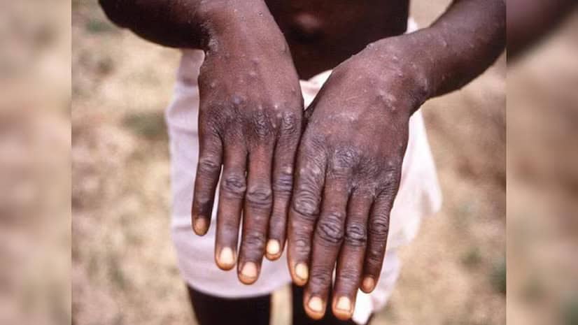 India Mpox: The Center issues a warning after getting the report of the first case of clade 1b infection 2 mp3 1 India Mpox: The Center issues a warning after getting the report of the first case of clade 1b infection