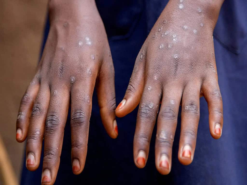 India Mpox: The Center issues a warning after getting the report of the first case of clade 1b infection 1 India Mpox