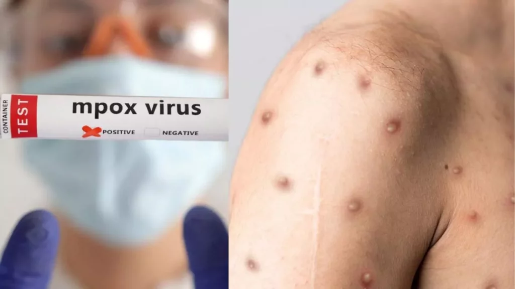 Kerala Second Mpox case