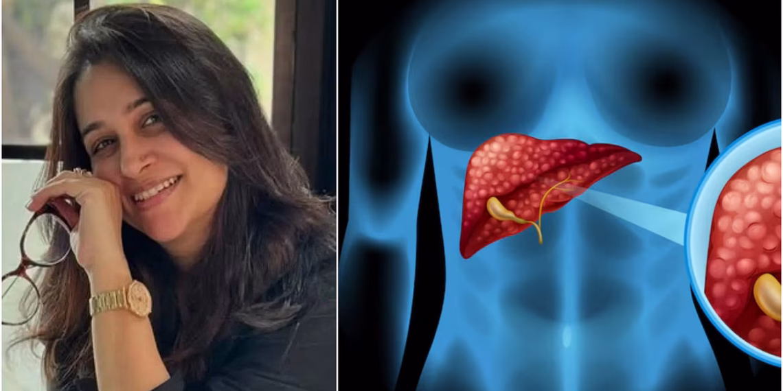 Dipika kakar liver tumor