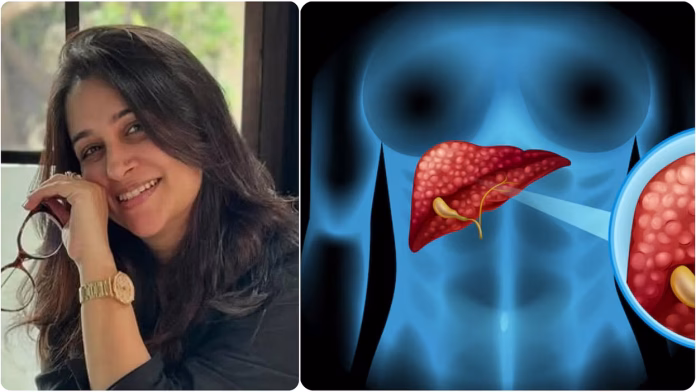 dipika-kakar-liver-tumor Dipika kakar liver tumor